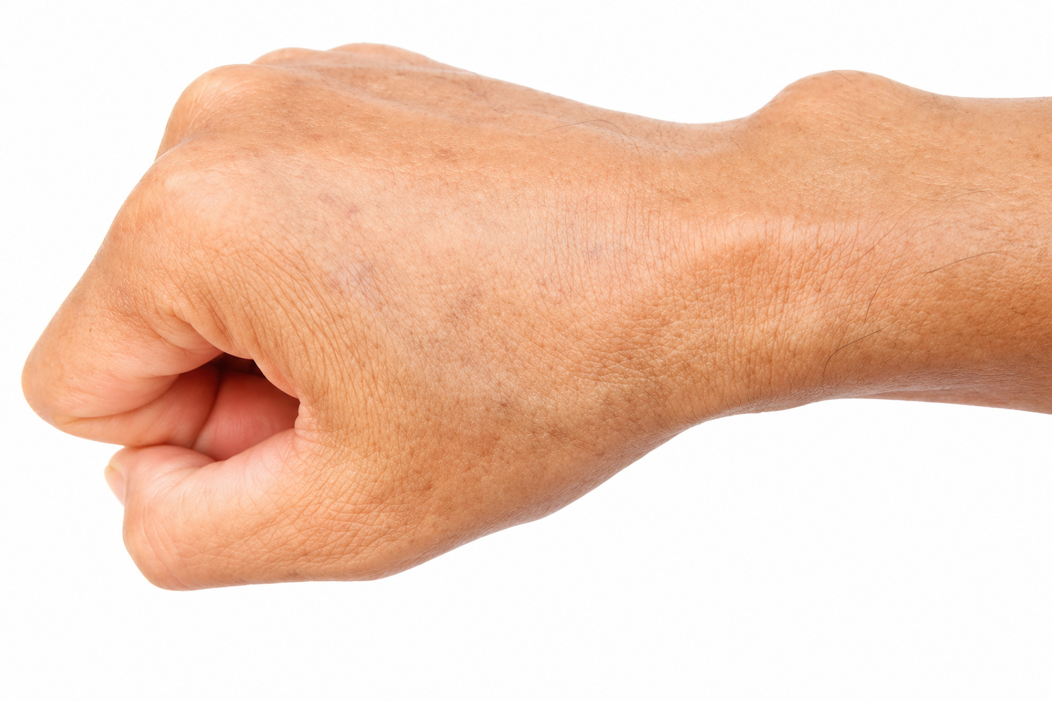 Tumours of hand and upper limb