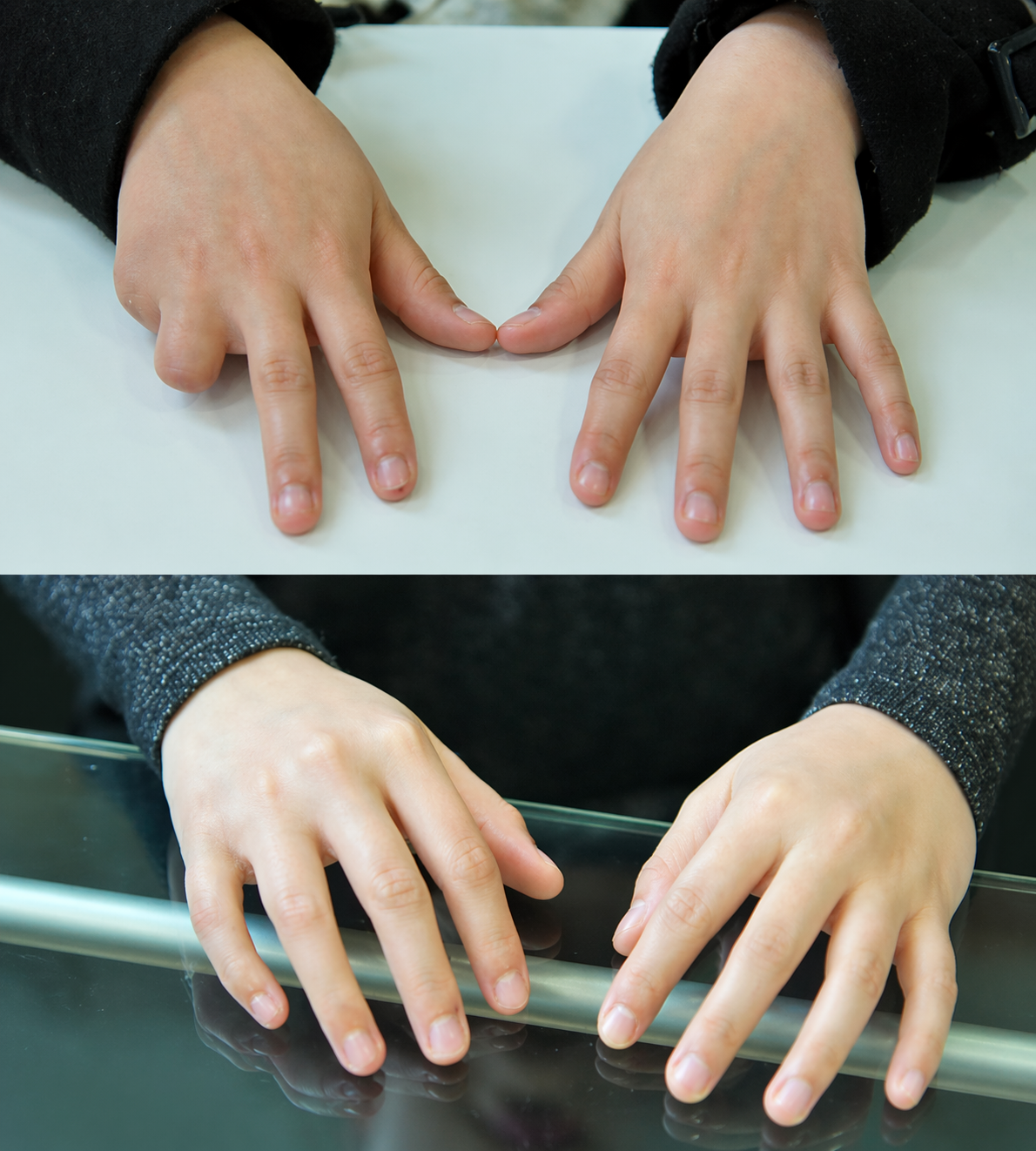 Hand Surgery success story