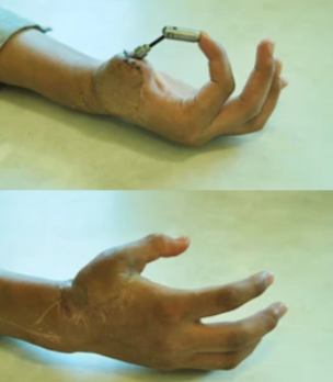 Hand Prosthetic success story